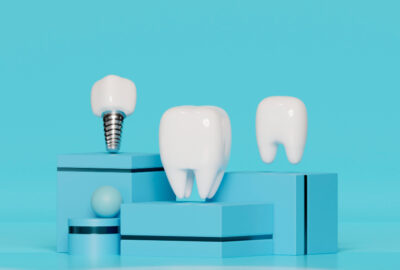 échecs en implantologie