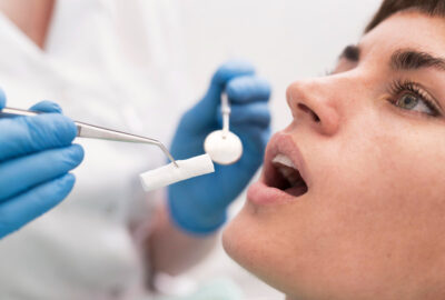 Microfissures de l’émail