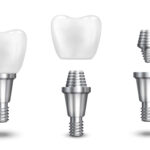 Implants dentaires