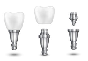 Implants dentaires