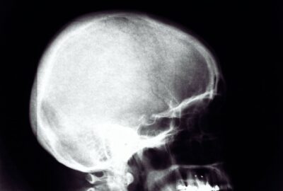 Kyste odontogène : diagnostic et prise en charge chirurgicale