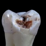 caries et risques cardiovasculaires