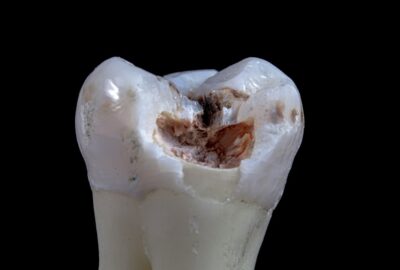 caries et risques cardiovasculaires