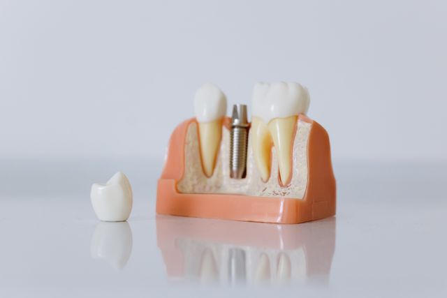 dental bone graft surgery illustration - cabinet dentaire greffe osseuse